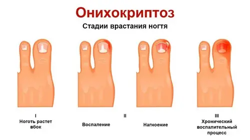 onihokriptoza stadij uraslog nokta