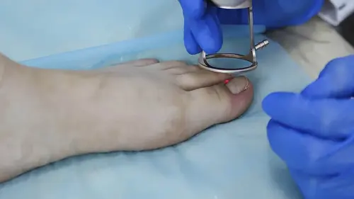 uklanjanje uraslog nokta